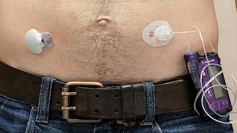 NHS implanta pâncreas artificial e reduz desigualdade no diabetes
