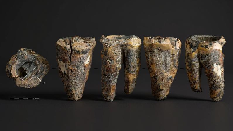 Neandertais podem ter removido cáries com ferramentas de pedra