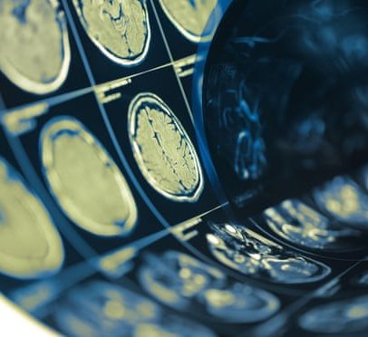 AVCs lacunares ligados à dilatação de artérias cerebrais, estudo sugere