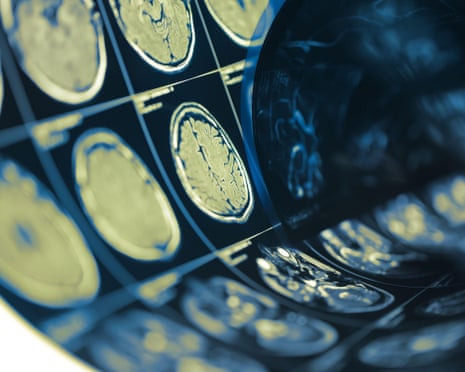 AVCs lacunares ligados à dilatação de artérias cerebrais, estudo sugere