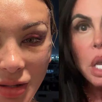 Andressa Urach aparece com rosto deformado após plástica; web reage