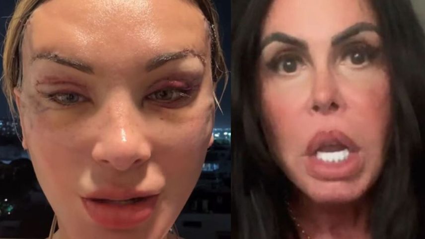 Andressa Urach aparece com rosto deformado após plástica; web reage