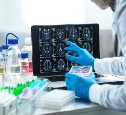 Alzheimer diagnóstico tardio no Reino Unido reduz acesso a terapias experimentais