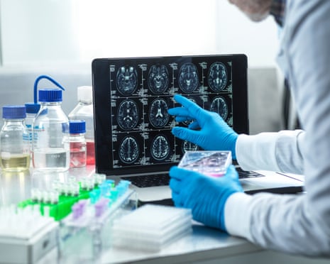 Alzheimer diagnóstico tardio no Reino Unido reduz acesso a terapias experimentais