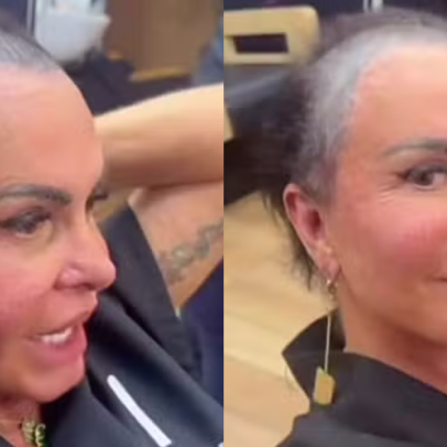 Gretchen diz que micropigmentação piorou alopecia; médicos discutem complicações