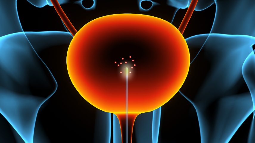 MIT researchers have developed a new approach for monitoring bladder cancer patients that could allow recurring tumors to be detected much earlier. Using a catheter coated with specialized nanosensors, the team was able to detect extremely low levels of a protein produced by bladder cancer cells and pinpoint their location within tissue.