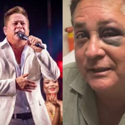 Leonardo detalha acidente que causou fratura facial e comenta estar alcoolizado