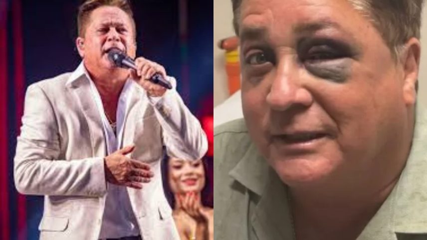 Leonardo fala sobre queda que deixou o olho roxo — Foto: Reprodução/Instagram