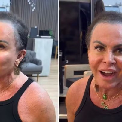 Gretchen explica causa da alopecia após aparecer sem prótese capilar