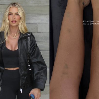 Yasmin Brunet volta a mostrar hematomas e fala sobre lipedema
