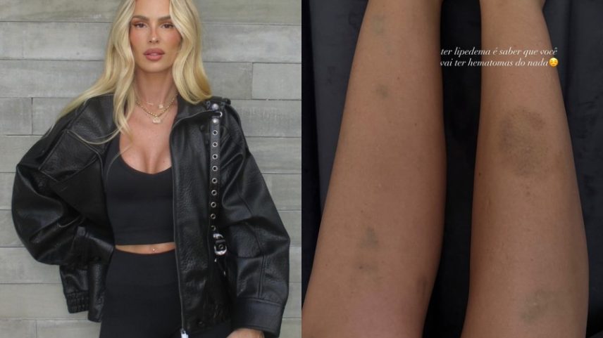 Yasmin Brunet volta a mostrar hematomas nas pernas e desabafa sobre lipedema — Foto: Reprodução/Instagram