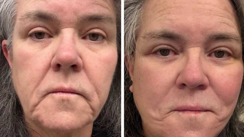 Rosie O’Donnell posted before-and-after facelift photos after getting candid about the “shameful” cost of the procedure.