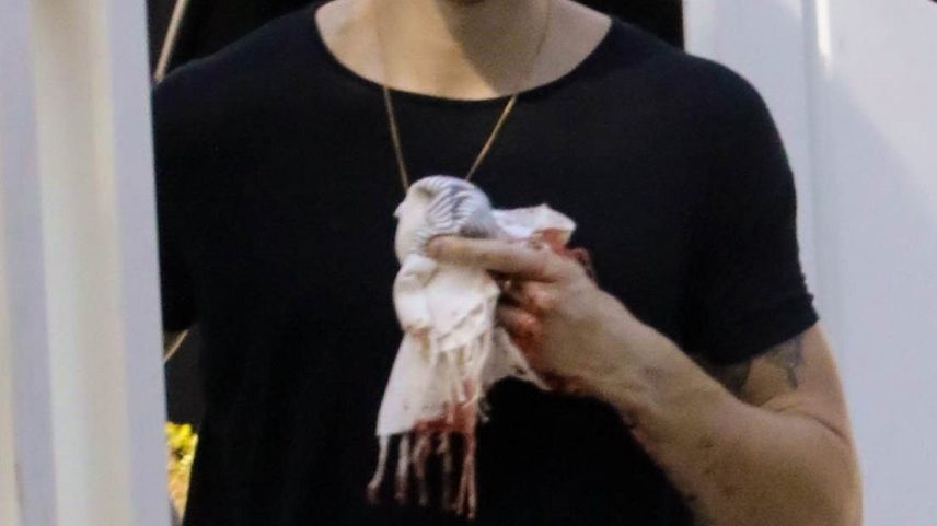 Shawn Mendes suffered a hand injury Tuesday.