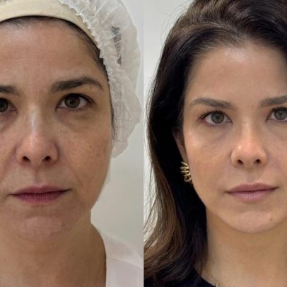 Samara Felippo mostra detalhes de rejuvenescimento facial e antes e depois