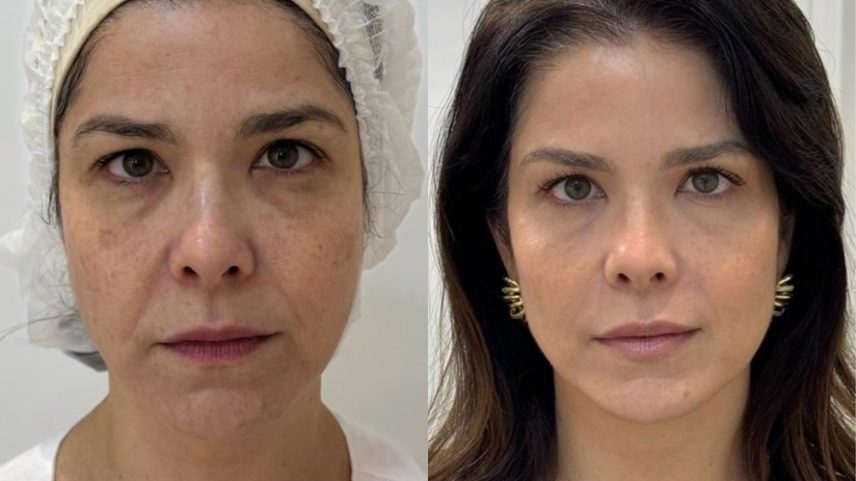Samara Felippo mostra detalhes de rejuvenescimento facial e antes e depois