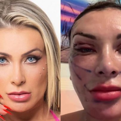 Andressa Urach exibe resultado de facelift profundo para parecer ter 23 anos
