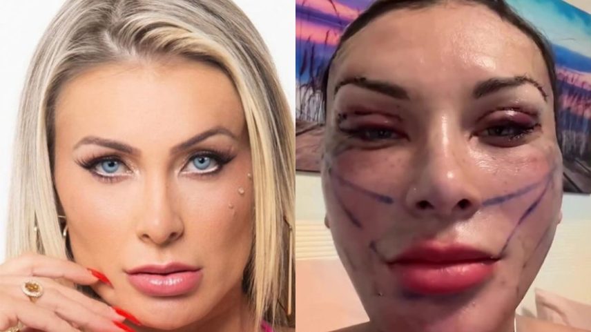 Andressa Urach exibe resultado de facelift profundo para parecer ter 23 anos