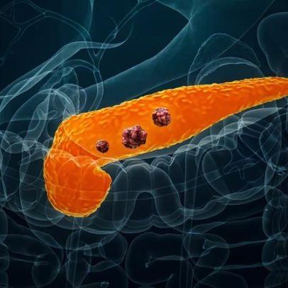Novo medicamento para câncer de pâncreas aumenta a sobrevida de pacientes