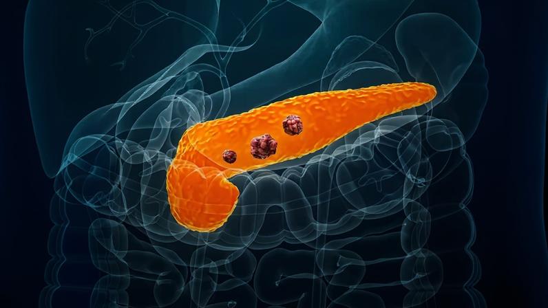 Novo medicamento para câncer de pâncreas aumenta a sobrevida de pacientes