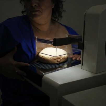 ANS defende cobertura de mamografia digital sem restrição de idade pelos planos