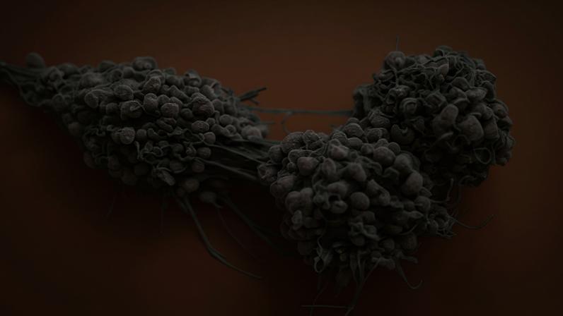 A coloured scanning electron micrograph of ovarian cancer cells. Ovarian is the 18th most common type of cancer globally.