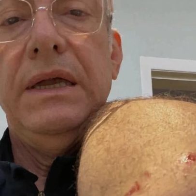 Jornalista José Roberto Burnier é atacado por pitbull e recebe 4 pontos