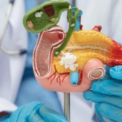 Medicamento amplia sobrevida em câncer de pâncreas