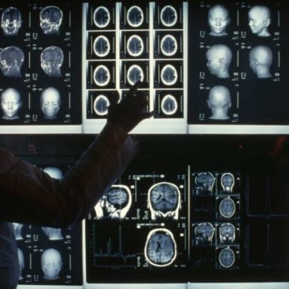 Terapias com RNAs e vírus modificados avançam contra o câncer cerebral