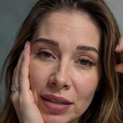 Maíra Cardi revela deformidades no rosto e risco de paralisia após estética