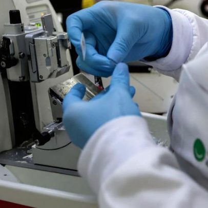 SUS inclui nova terapia para pacientes adultos com leucemia mieloide