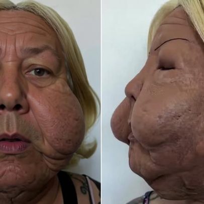Médico mostra antes e depois de remover óleo mineral do rosto de Juju do Pix