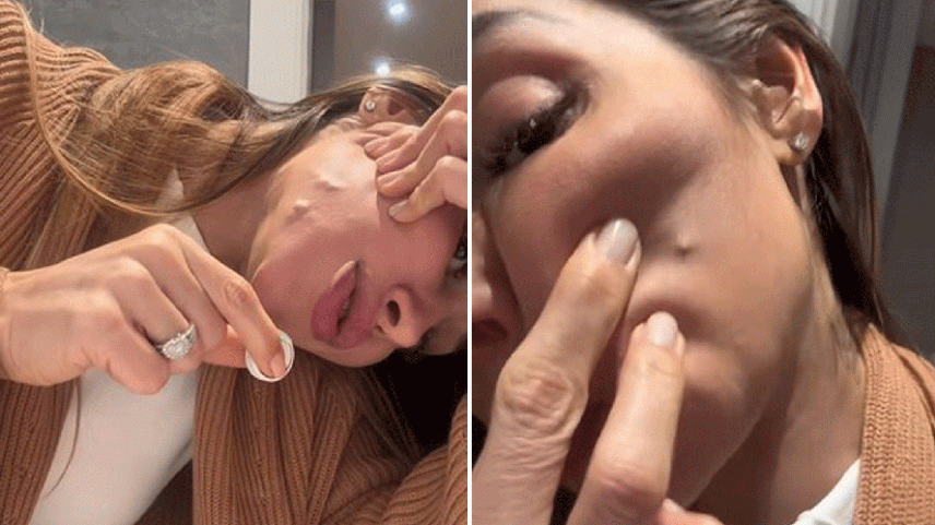 Maíra Cardi mostra deformidades associadas ao PMMA aplicado há 20 anos — Foto: Reprodução/TikTok