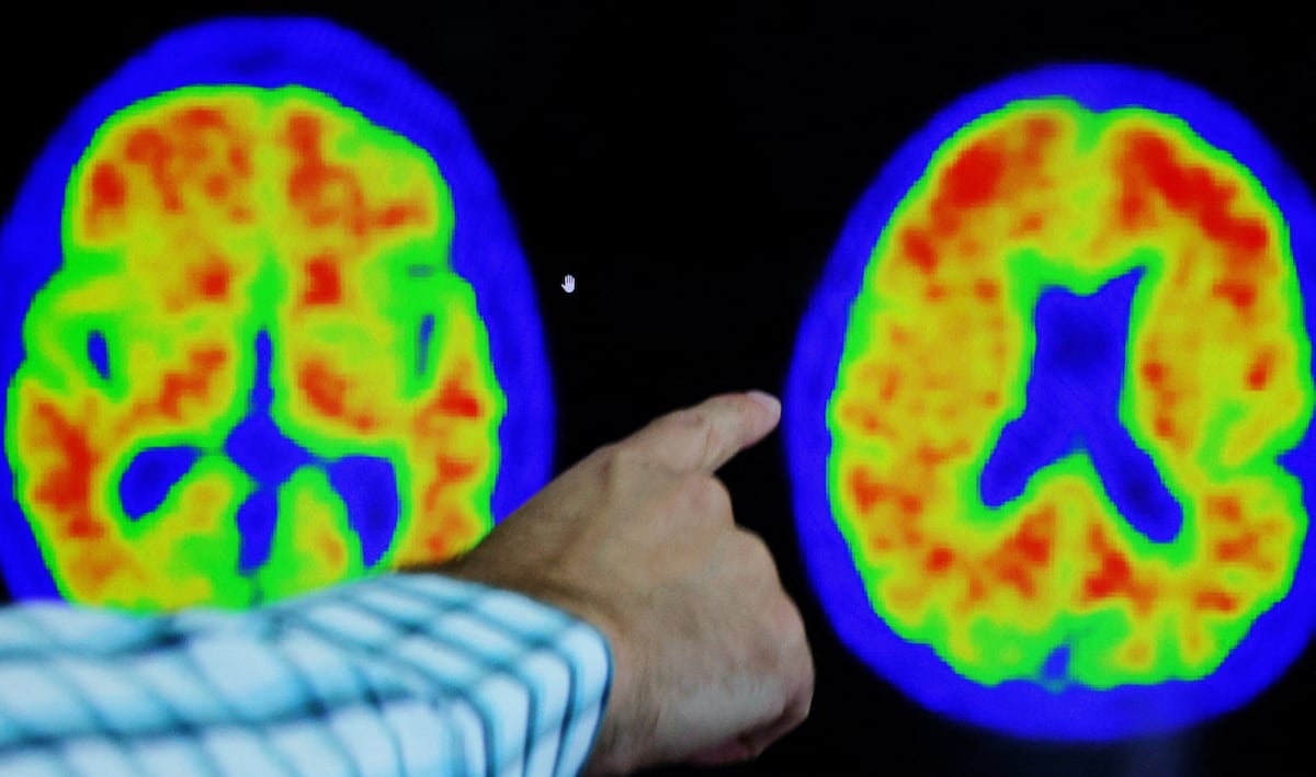 Cientistas criam mapa molecular que pode revolucionar tratamento do alzhéimer e parkinson As medições de proteínas no plasma sanguíneo ou no líquido cefalorraquídeo complementarão outros dados, como a tomografia, para entender doenças como o Alzheimer (Foto: BRIAN SNYDER/REUTERS)