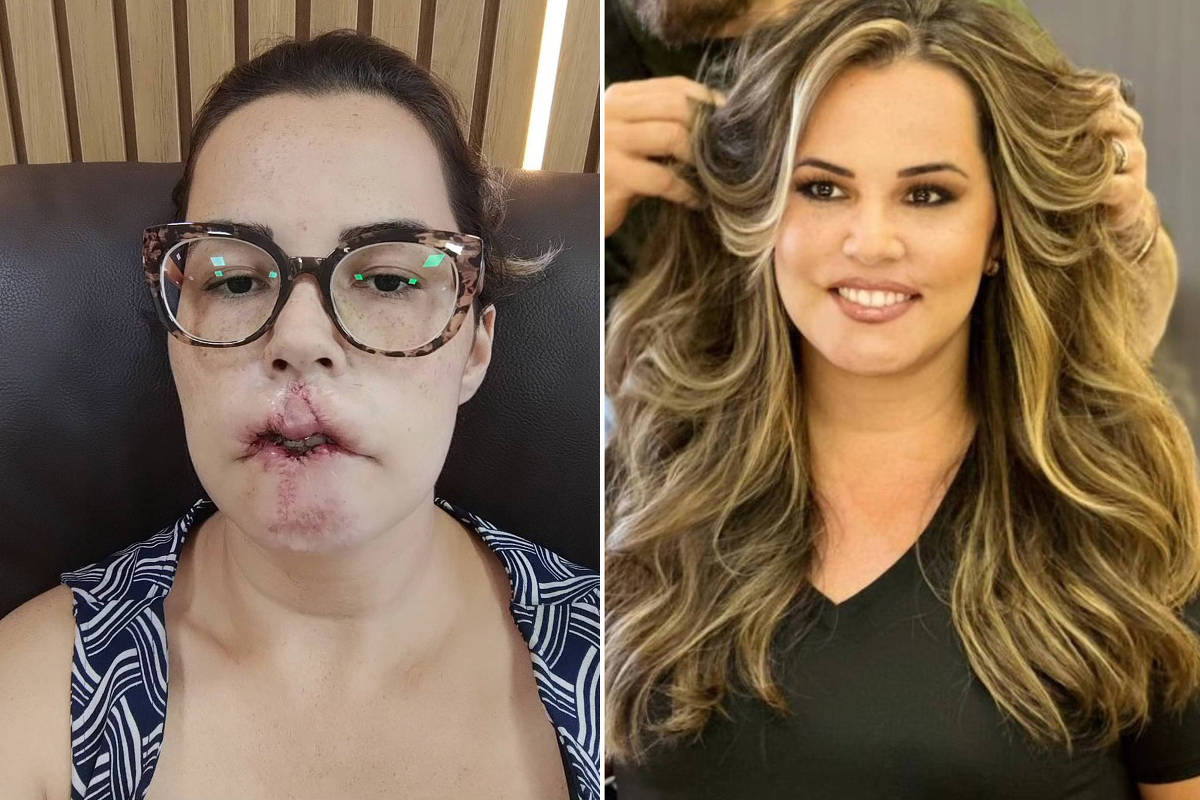 Mariana Michelini em 2022, após a cirurgia para remoção do PMMA e de parte dos lábios; à direita, em janeiro de 2025, após as cirurgias de reconstrução (Foto: @mari_michelini no Instagram)