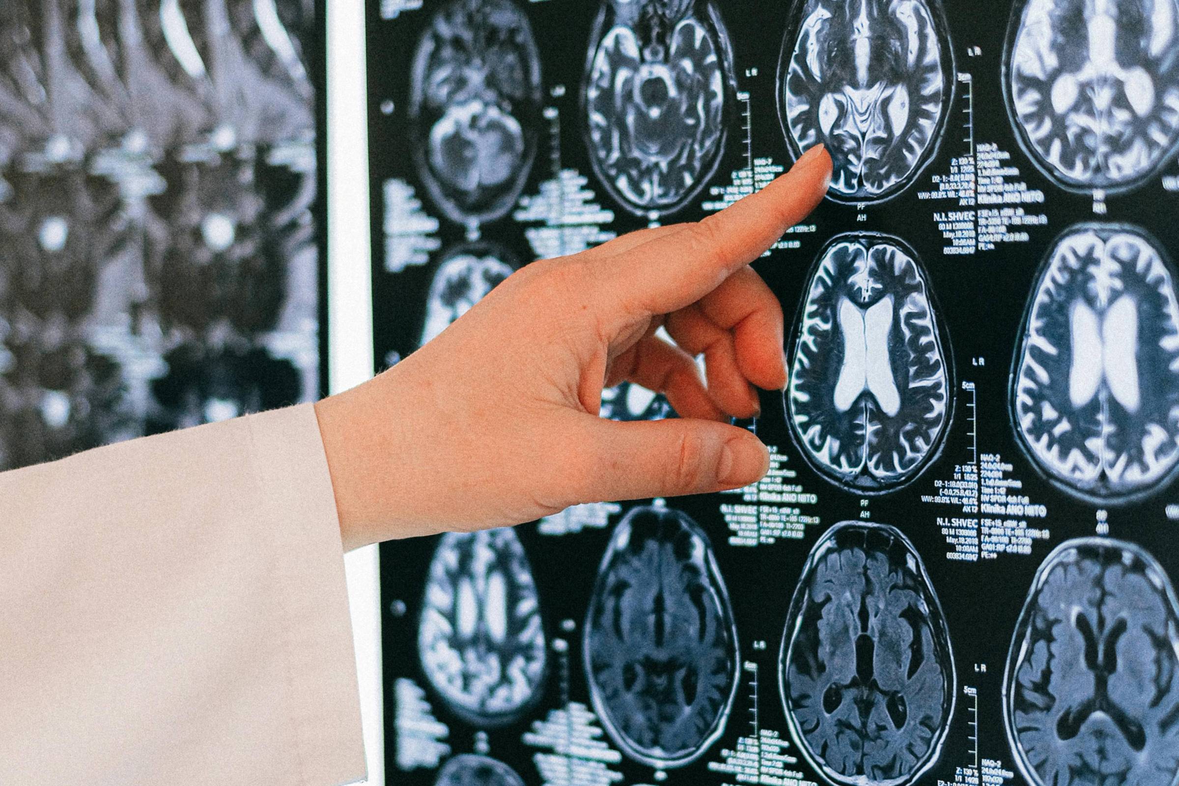 Pesquisa revela que estruturas cerebrais não causam psicopatia diretamente A associação entre diferenças em estruturas cerebrais e psicopatia é real, mas não é necessariamente determinista para o desenvolvimento do transtorno (Foto: Anna Shvets/Pexels)